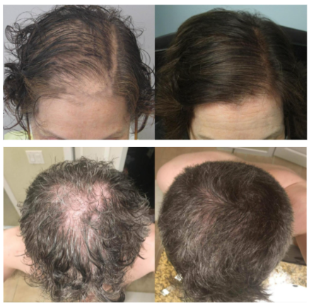 folicrex before and after pictures