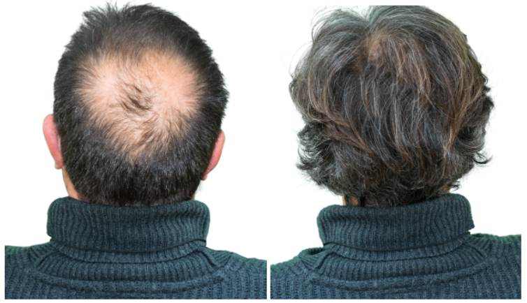 Re-Nourish Hair Growth before and after back side