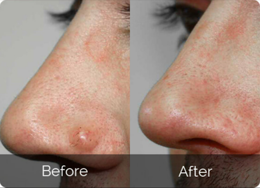 Customer before and after images of Silky Skin Tag Remover