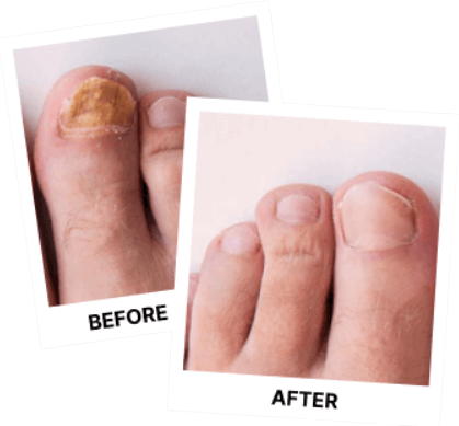 Nature's Remedy Fungi Remover Before and After Result