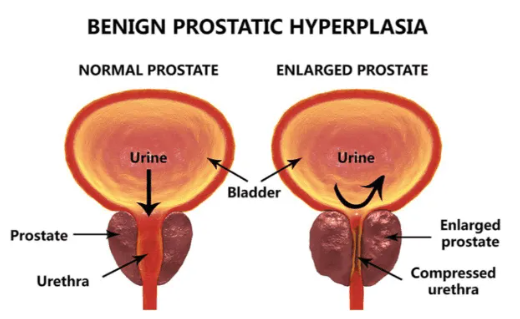 ProstateFlux Supplement