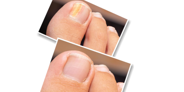 Effective Toenail Fungus Treatment Image