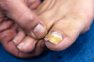 Hydrogen Peroxide for Toenail Fungus