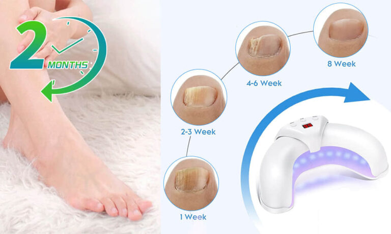 Treating Toenail Fungus at Home How Does it work